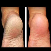 ژل ازبین برنده خشکی پوست برای کل ناحیه پوست