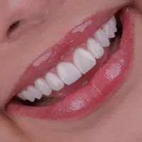 ایمپلنت/کامپوزیت/دندانپزشکی با اقساط ۶۰ ماهه