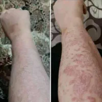 از خارش ودرد خسته شدی