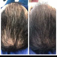 تزریق ژل و بوتاکس|خدمات زیبایی و سلامت|تهران, سجاد|دیوار