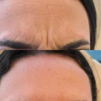 جشنواره ۵۰درصد تخفیف بوتاکس مخصوص خانم ها و آقایان|خدمات آرایشگری و زیبایی|دزفول, |دیوار