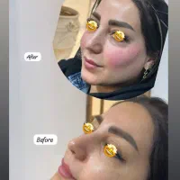 تزریق ژل بوتاکس سفیدکننده پوست لیزر و prpدر مطب700