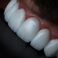 ایمپلنت کره ای با روکش ۱۲۹۰۰/دندانپزشکی|خدمات آرایشگری و زیبایی|تهران, تهرانپارس غربی|دیوار
