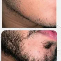 تکنولوژیِ جدید رشد ریش