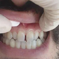 جشنواره دندانپزشکی با بالاترین کیفیت  تخفیف|خدمات آرایشگری و زیبایی|اردبیل, |دیوار