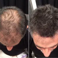 درمان ریزش مو ورشد مجدد مو