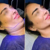 خدمات زیبایی و جوانسازی ساکشن ،بلفارو ،کاشت،فیلر