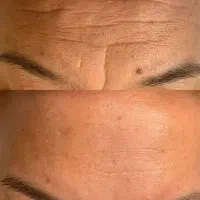 منافذ/لک/جوانسازی/افتادگی/لیفت