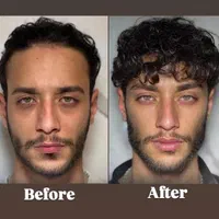 تزریق فیلر ژل/بوتاکس/prp پوست مو/پی آر‌پی/مزوتراپی|خدمات آرایشگری و زیبایی|کرج, گوهردشت|دیوار