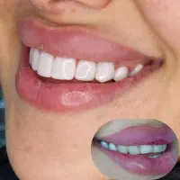 کامپوزیت زیبایی واحدی ۱،۶۰۰