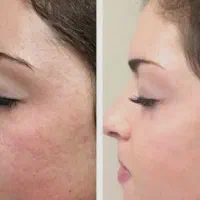 آف ۵۰ درصدی فیشیال صورت و بر داشتن خال و زگیل