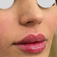 تزریق و اموزش ژل و بوتاکس با قیمت خوب