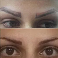 پاک کردن و ریموو تاتو صورت بدون عوارض و در یک جلسه|خدمات آرایشگری و زیبایی|تهران, دهکده المپیک|دیوار