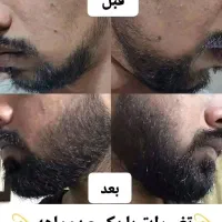 درمان تضمینی کمپشتی ریش و سیبیل