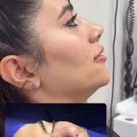 جراحی و عمل بینی/پیکرتراشی/لیفت/پلک|خدمات آرایشگری و زیبایی|فردیس, طالقانی|دیوار
