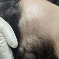 درمان ریزش مو|خدمات آرایشگری و زیبایی|رشت, بلوار گیلان|دیوار