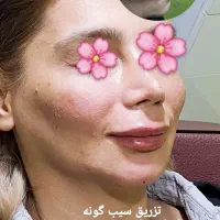 ۲۰ درصد تخفیف خدمات ژل و بوتاکس|خدمات آرایشگری و زیبایی|دوگنبدان, |دیوار