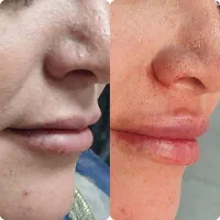 مدل تزریق فیلر جهت تولید محتوا