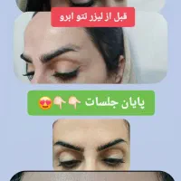 لیزرتتوابرو،لیزرهالیوودی کیوسوئیچ|خدمات آرایشگری و زیبایی|بروجرد, |دیوار