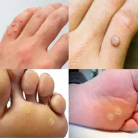 برداشت میخچه خال زگیل جراحی لیپوم لیزری توسط پزشک|خدمات آرایشگری و زیبایی|مشهد, توس (بلوار توس)|دیوار