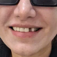 دندان مصنوعی ژلهای انعطاف پذیر تحویل فوری|خدمات زیبایی و سلامت|تهران, فردوس|دیوار