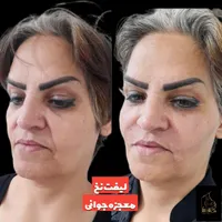 لیفت نخ معجزه جوانی و لیفتینگ صورت بدون جراحی|خدمات آرایشگری و زیبایی|شاهین‌شهر, فردوسی|دیوار