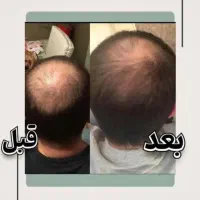 درمان بی قید و شرط ریزش مو کمتر از دوماه
