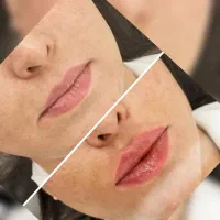 آف ویژه ژل وفیلرو بوتاکس تا اواخر مردادماه|خدمات آرایشگری و زیبایی|شیراز, شهرک گلدشت حافظ‎|دیوار