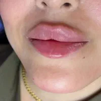 فیلر و بوتاکس