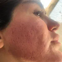 لیزر co2 تخفیف ویژه حذف اسکار،منافذوتیرگی ها مزو|خدمات آرایشگری و زیبایی|تهران, زعفرانیه|دیوار