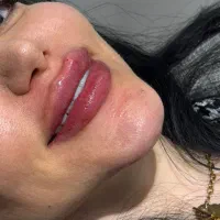 تزریقات بوتاکس ژل لب روسی فیلر مزوژل جوانساز