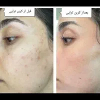 ۳۰٪ تخفیف لیزر موهای زائد /پاک کردن تتو/کربن تراپی|خدمات آرایشگری و زیبایی|بروجرد, |دیوار