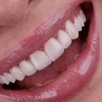 کامپوزیت دندان فکی ۷ میلیون اقساطی