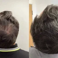 پی آر پی prp مزوتراپی مزونیدلینگ بوتاکس فشیال