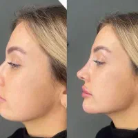 ژل و بوتاکس فیلر چربی مزو|خدمات آرایشگری و زیبایی|مشهد, طلاب|دیوار