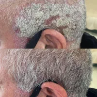 درمان تضمینی پیسی و پسوریازیس|خدمات آرایشگری و زیبایی|مشهد, انقلاب|دیوار