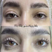 جراحی پلک بلفاروپلاستی ساکشن غبغب کاشت ابرو