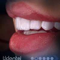 کامپوزیت لمینت ایمپلنت اقساط ویژه