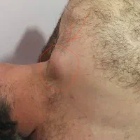 جراحی غده چربی (لیپوم)،و کیست مویی ،
