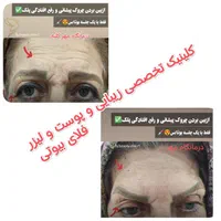 لیزر موهای زاید روشن سازی پاک کردن تتو دردرمانگاه|خدمات آرایشگری و زیبایی|شیراز, حافظیه|دیوار