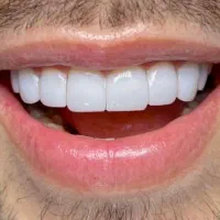 جشنواره‌ی بزرگ کامپوزیت دندان|خدمات آرایشگری و زیبایی|یاسوج, |دیوار