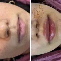 نیازمند مدل فیلر لب