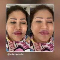 فیشال وپاکسازی پوست