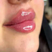 جشنواره تخصصی تزریق ژل و بوتاکس