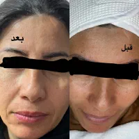 فیشال و پلاژن تراپی رفع تیرگی نواحی تیره بدن وصورت