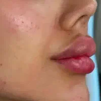 افرتزریقات ژل و بوتاکس