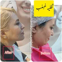 جشنواره ساکشن تخصصی غبغب و تزریق چربی اقساط|خدمات آرایشگری و زیبایی|تهران, شهر زیبا|دیوار