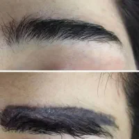 پاک کردن تاتو