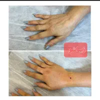 ساکشن شکم‌پهلوغبغب اندولیفت بلفارو|خدمات آرایشگری و زیبایی|شیراز, امام حسین|دیوار