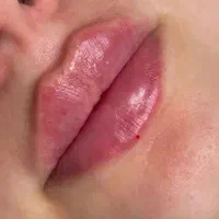 تزریق وآموزش فیلر و بوتاکس